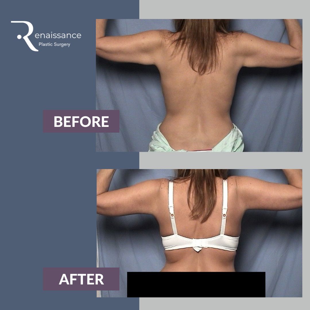 Brachioplasty Before and After 3 - Back