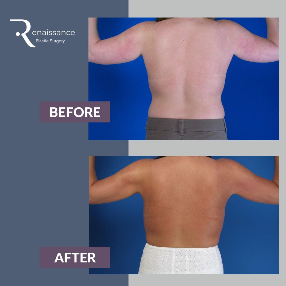 Brachioplasty Before and After 4 - Back