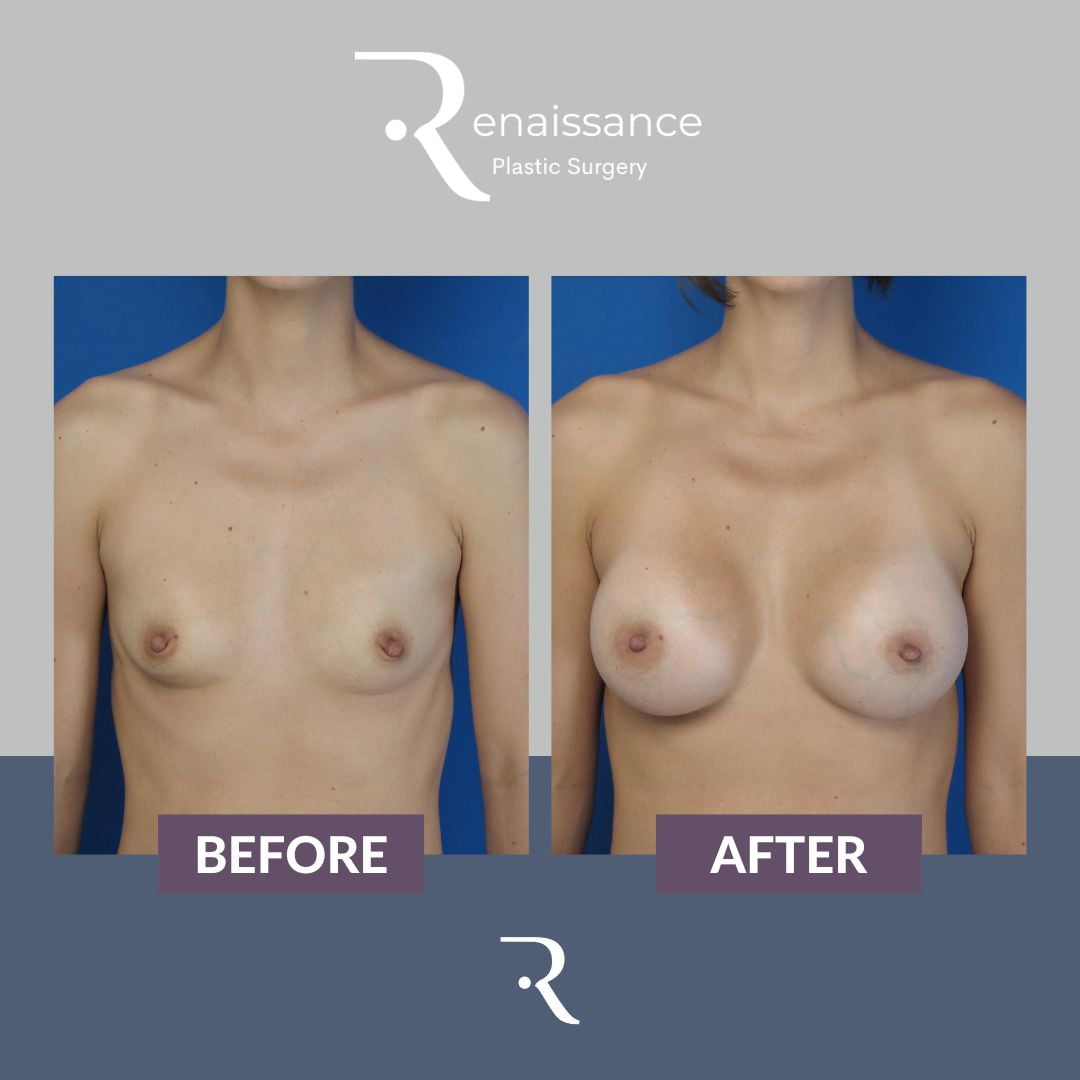 Breast Augmentation Before and After 1 - Front