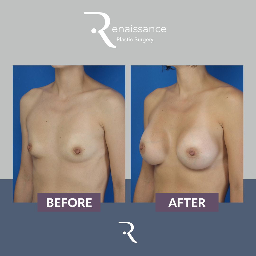 Breast Augmentation Before and After 1 - Side