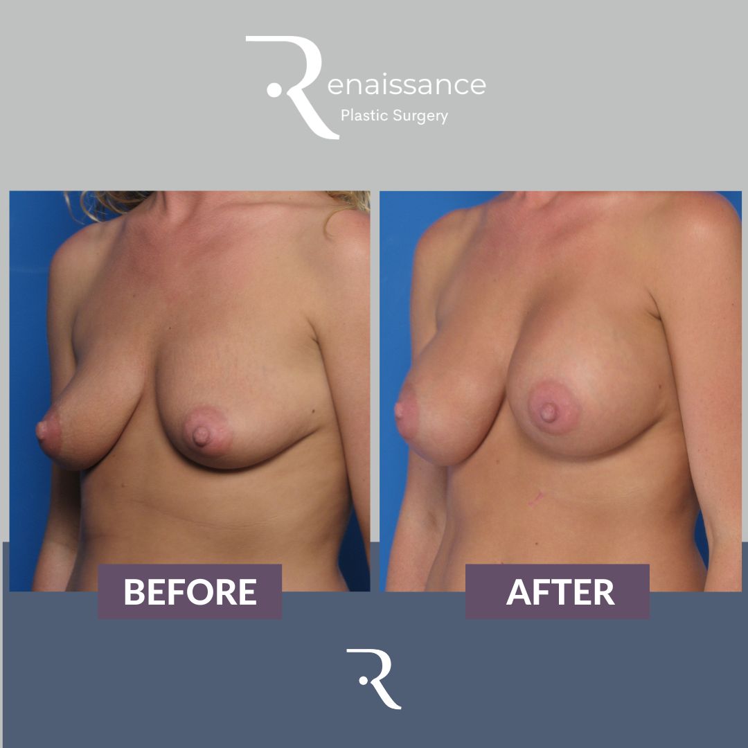 Breast Augmentation Before and After 10 - Side