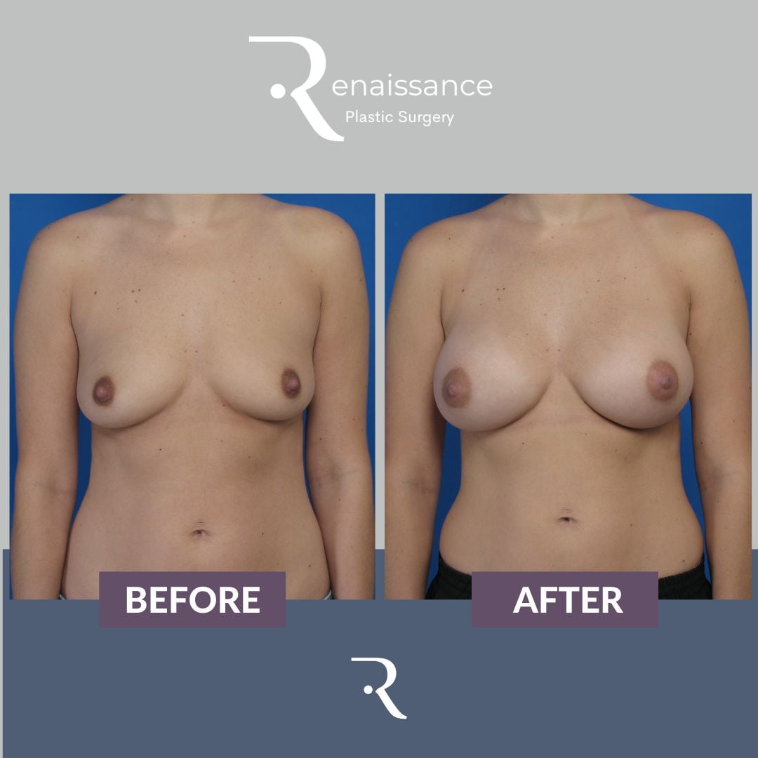 Breast Augmentation Before and After 11 - Front