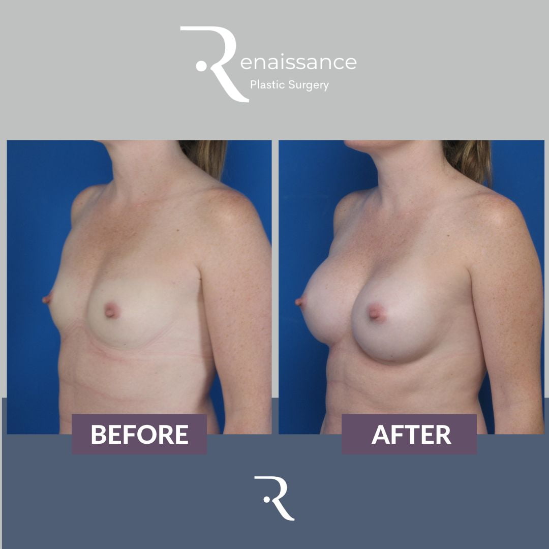 Breast Augmentation Before and After 12 - Side
