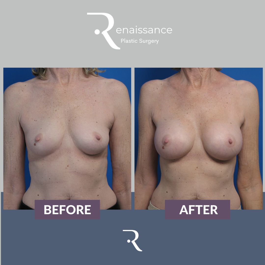 Breast Augmentation Before and After 13 - Front