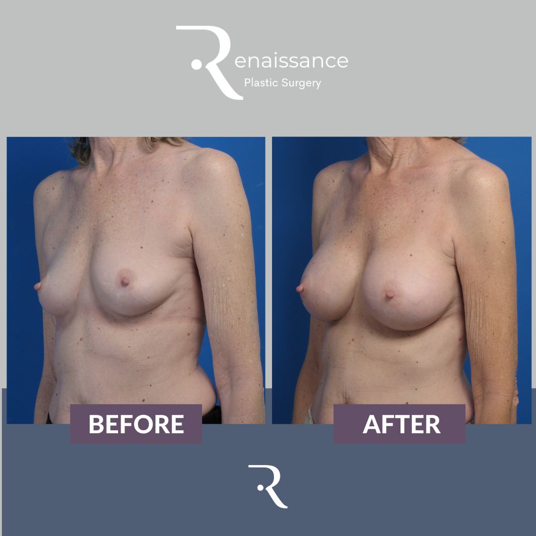 Breast Augmentation Before and After 13 - Side