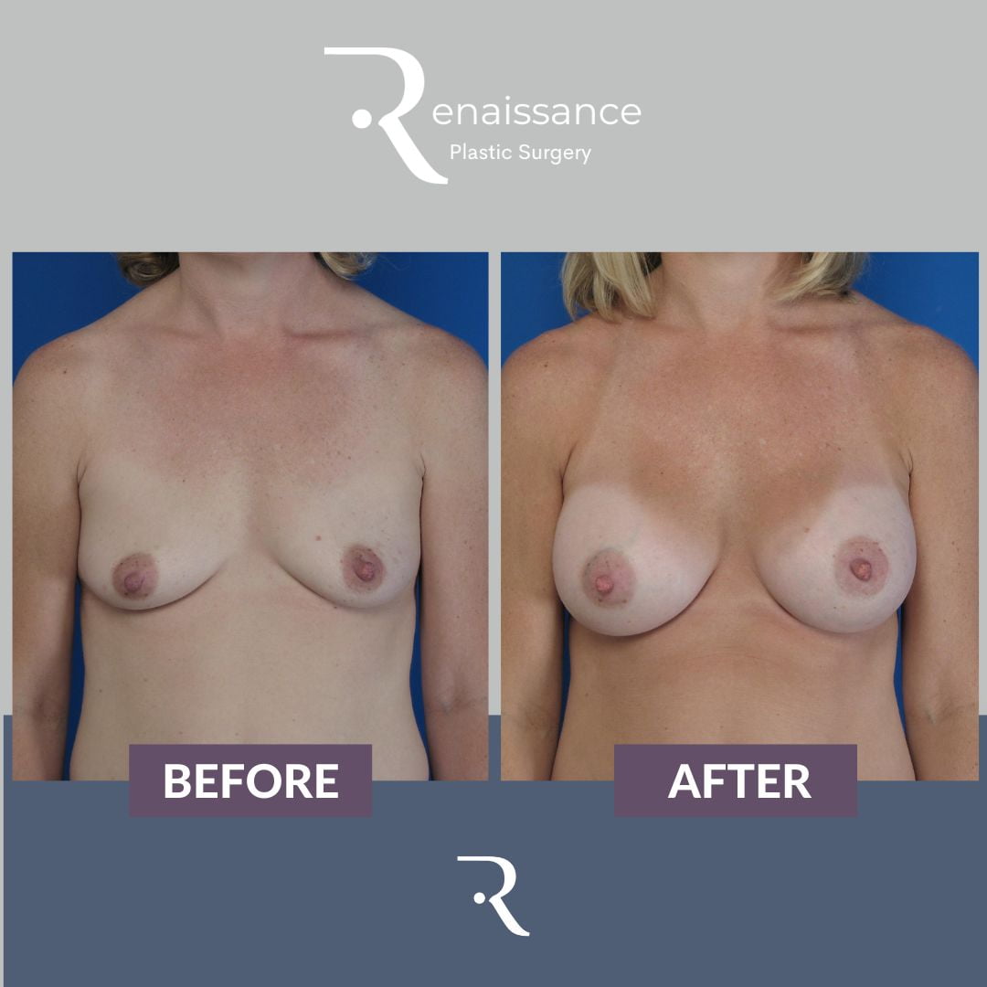 Breast Augmentation Before and After 14 - Front