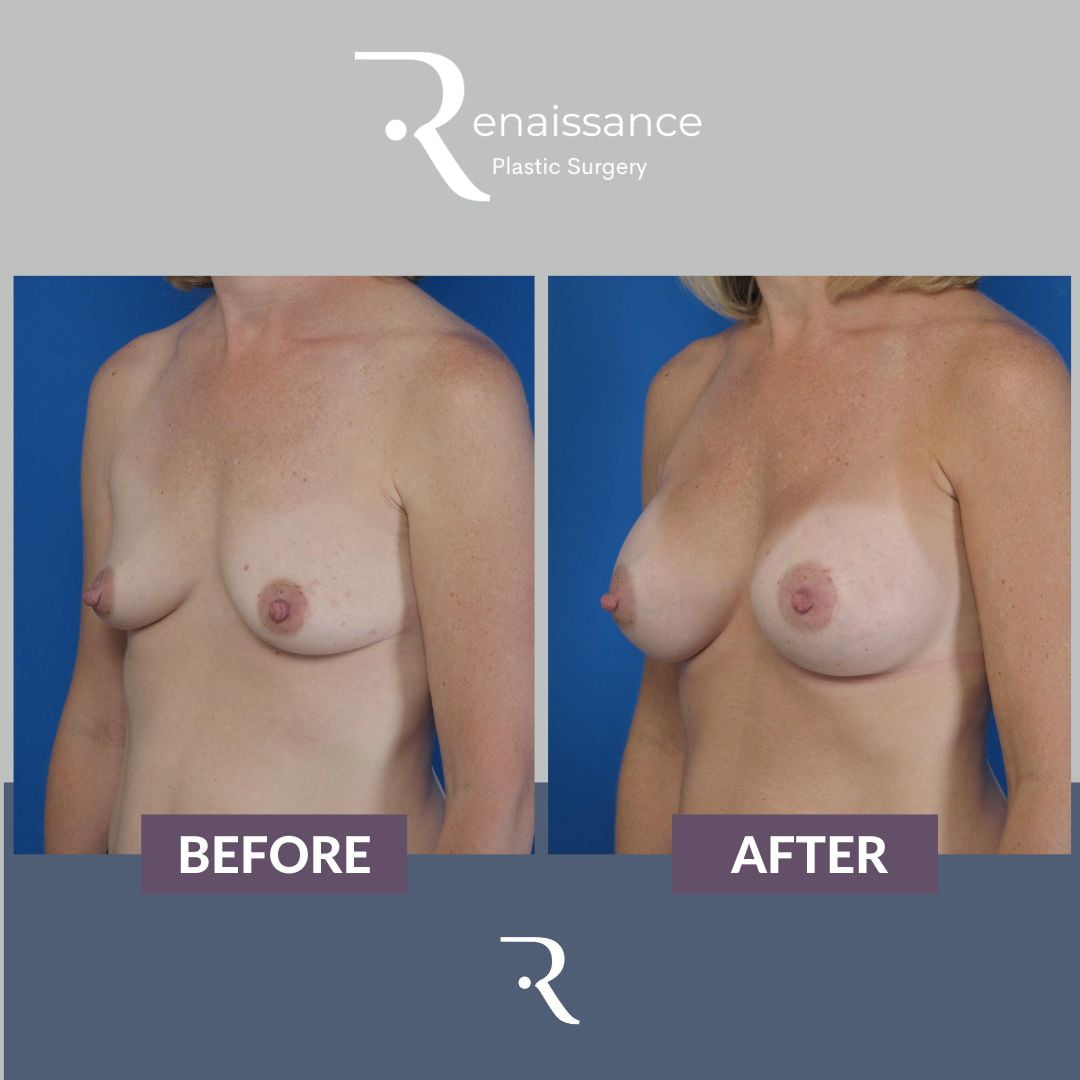 Breast Augmentation Before and After 14 - Side