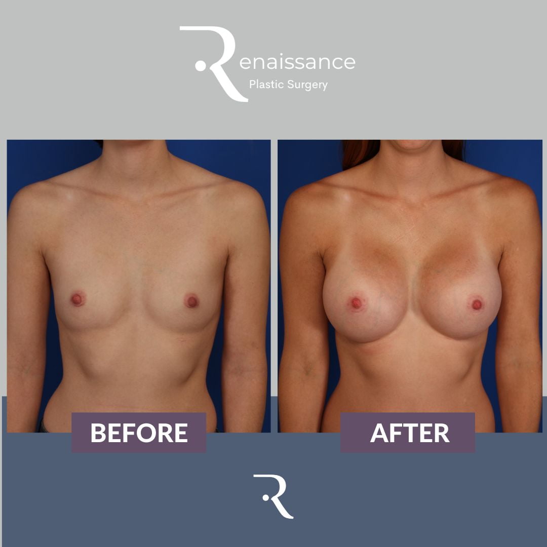 Breast Augmentation Before and After 15 - Front