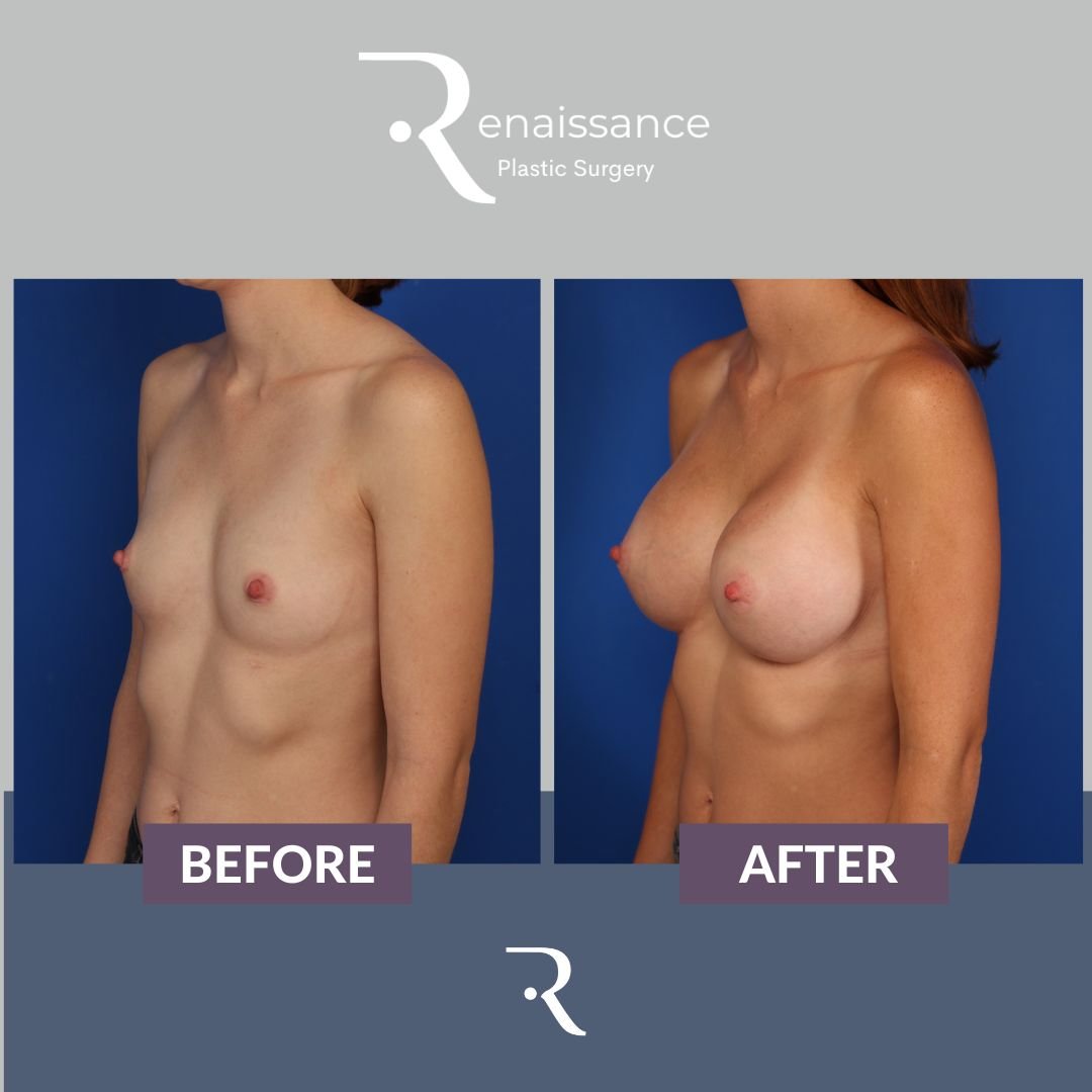 Breast Augmentation Before and After 15 - Side