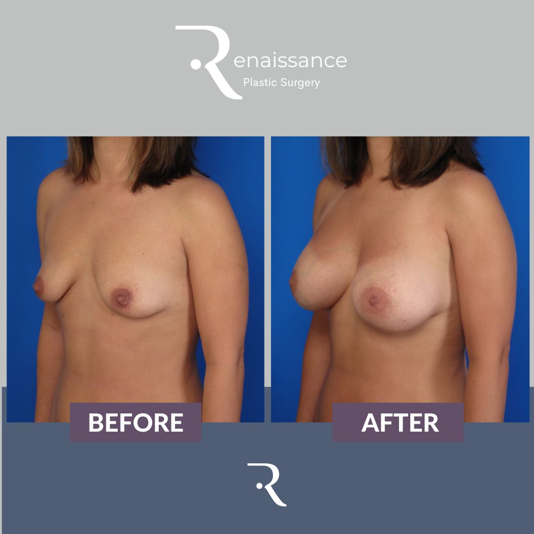 Breast Augmentation Before and After 16 - Side