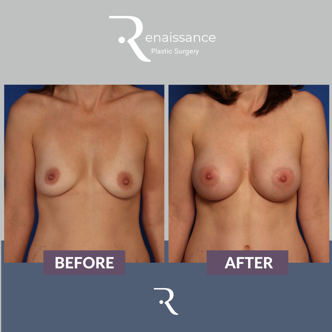 Breast Augmentation Before and After 18 - Front