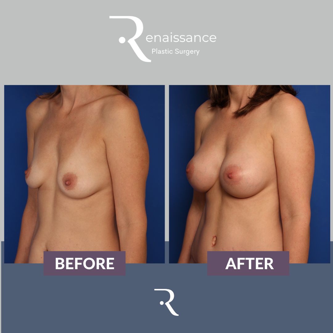 Breast Augmentation Before and After 18 - Side