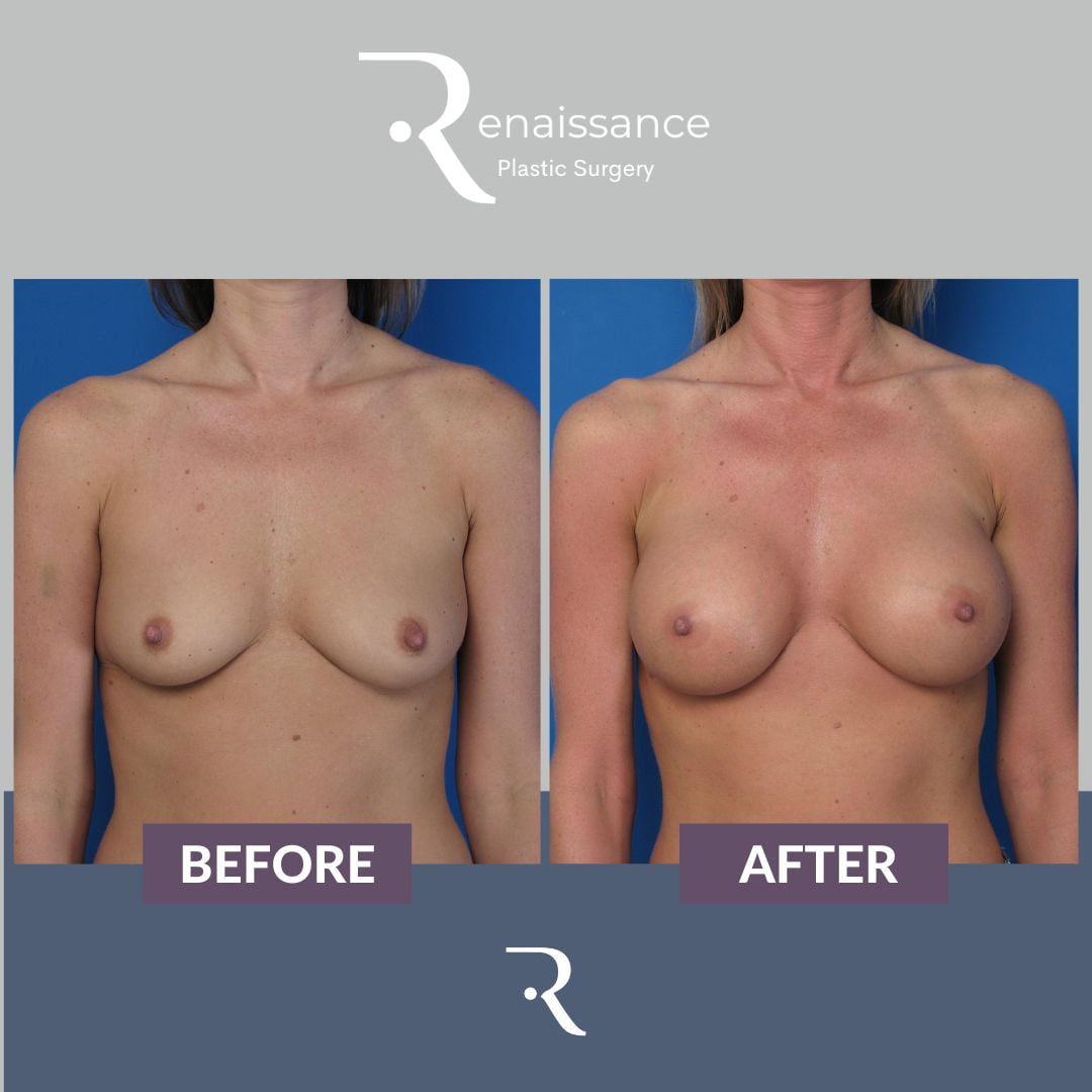 Breast Augmentation Before and After 2 - Front