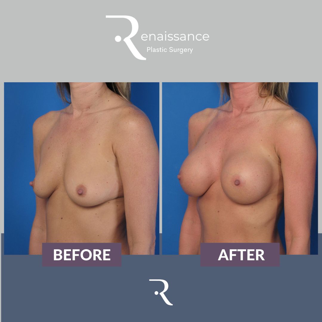 Breast Augmentation Before and After 2 - Side