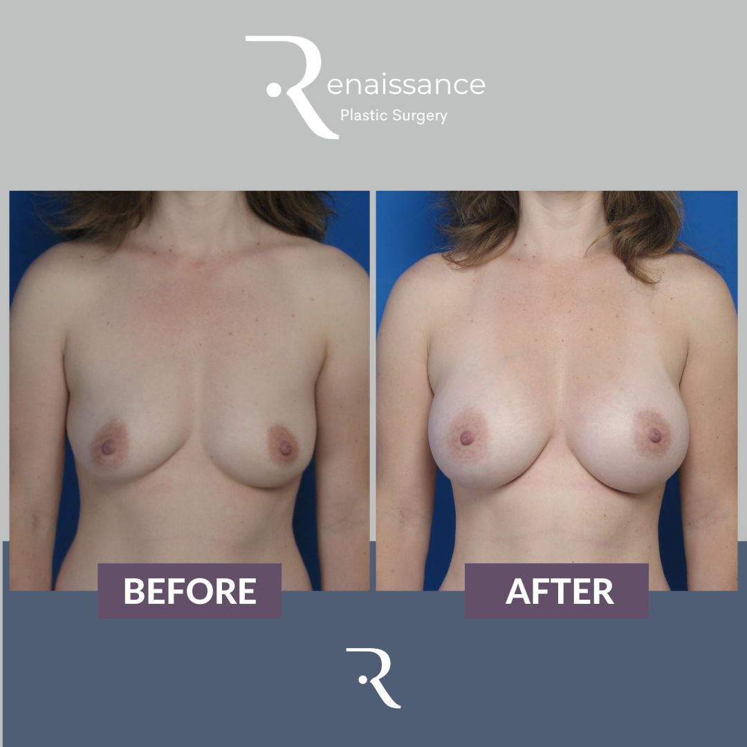 Breast Augmentation Before and After 4 - Front