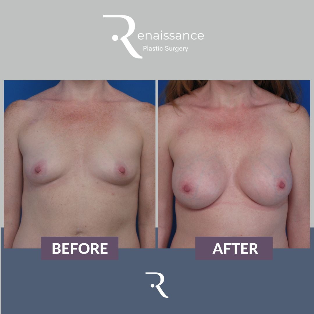 Breast Augmentation Before and After 5 - Front