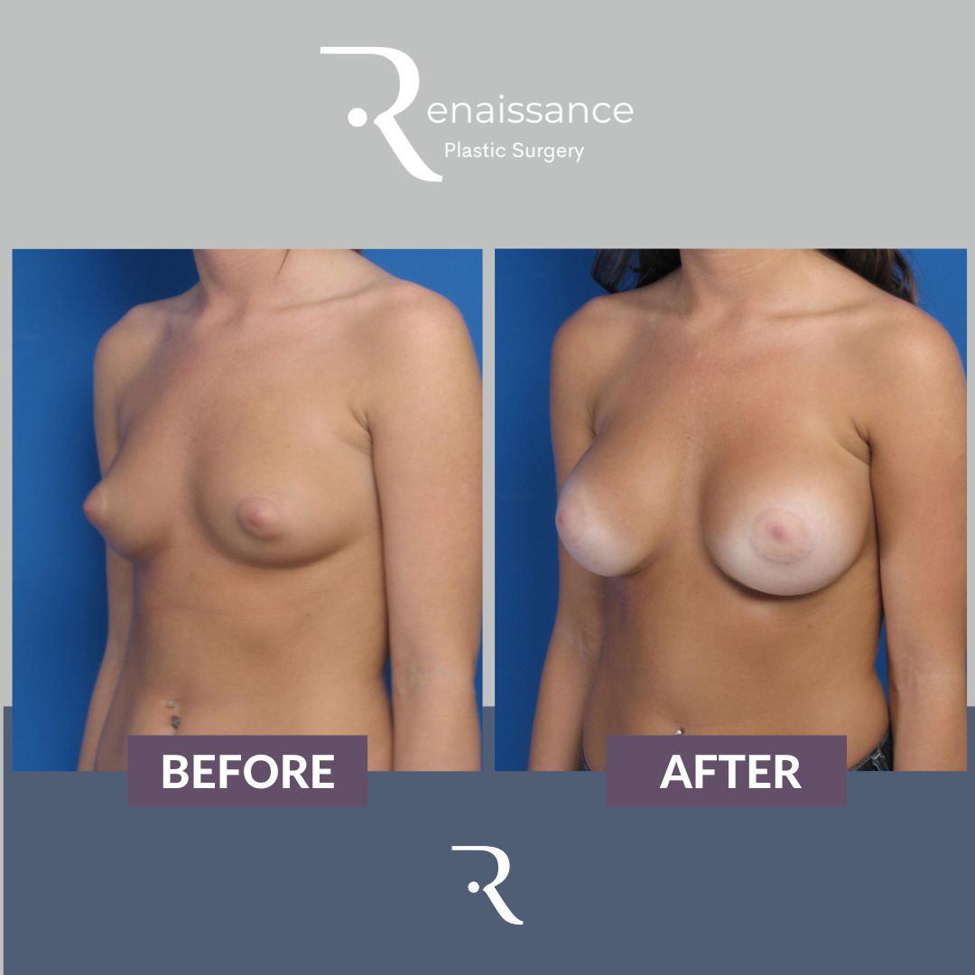 Breast Augmentation Before and After 6 - Side