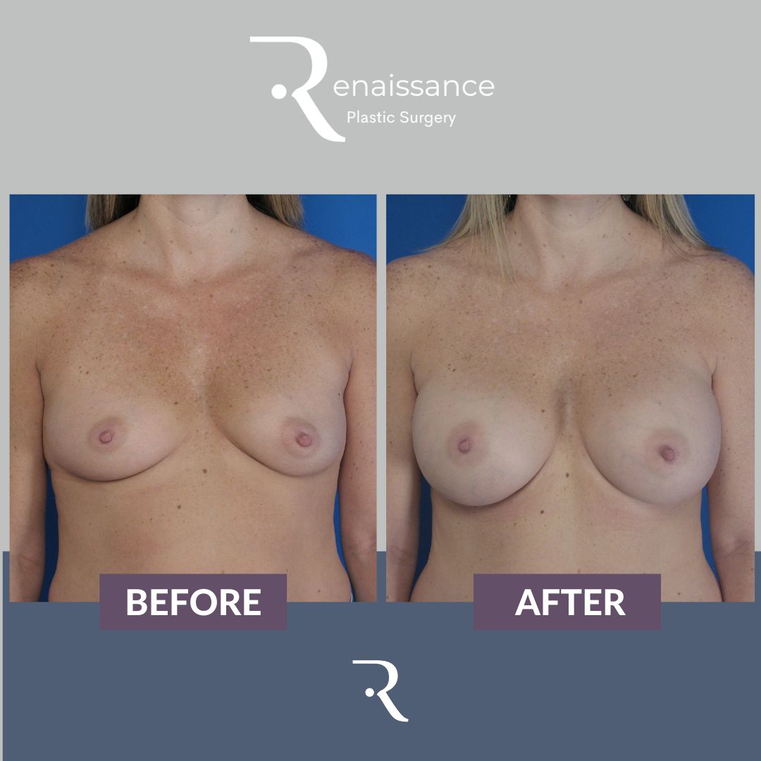 Breast Augmentation Before and After 7 - Front
