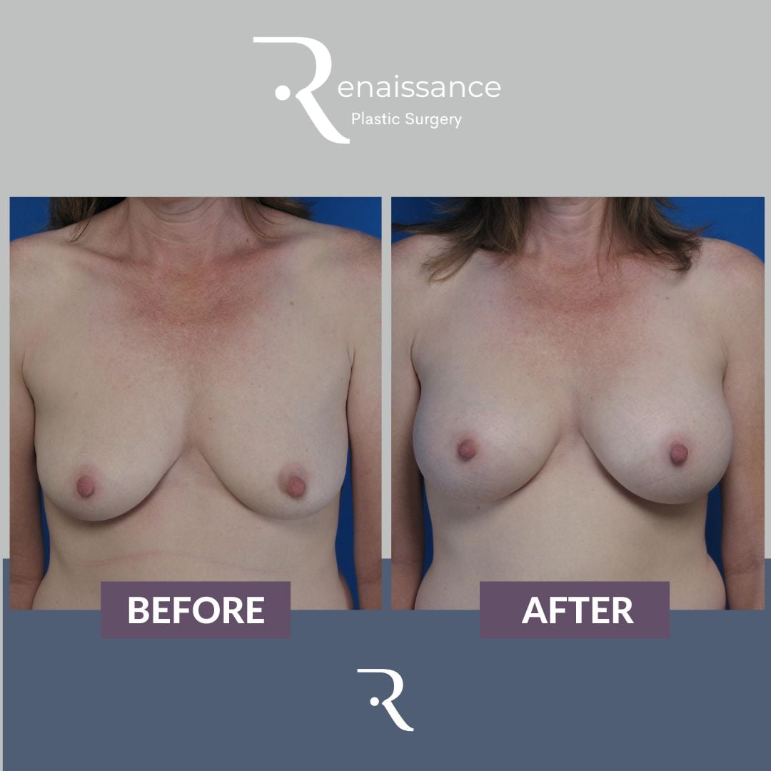 Breast Augmentation Before and After 8 - Front