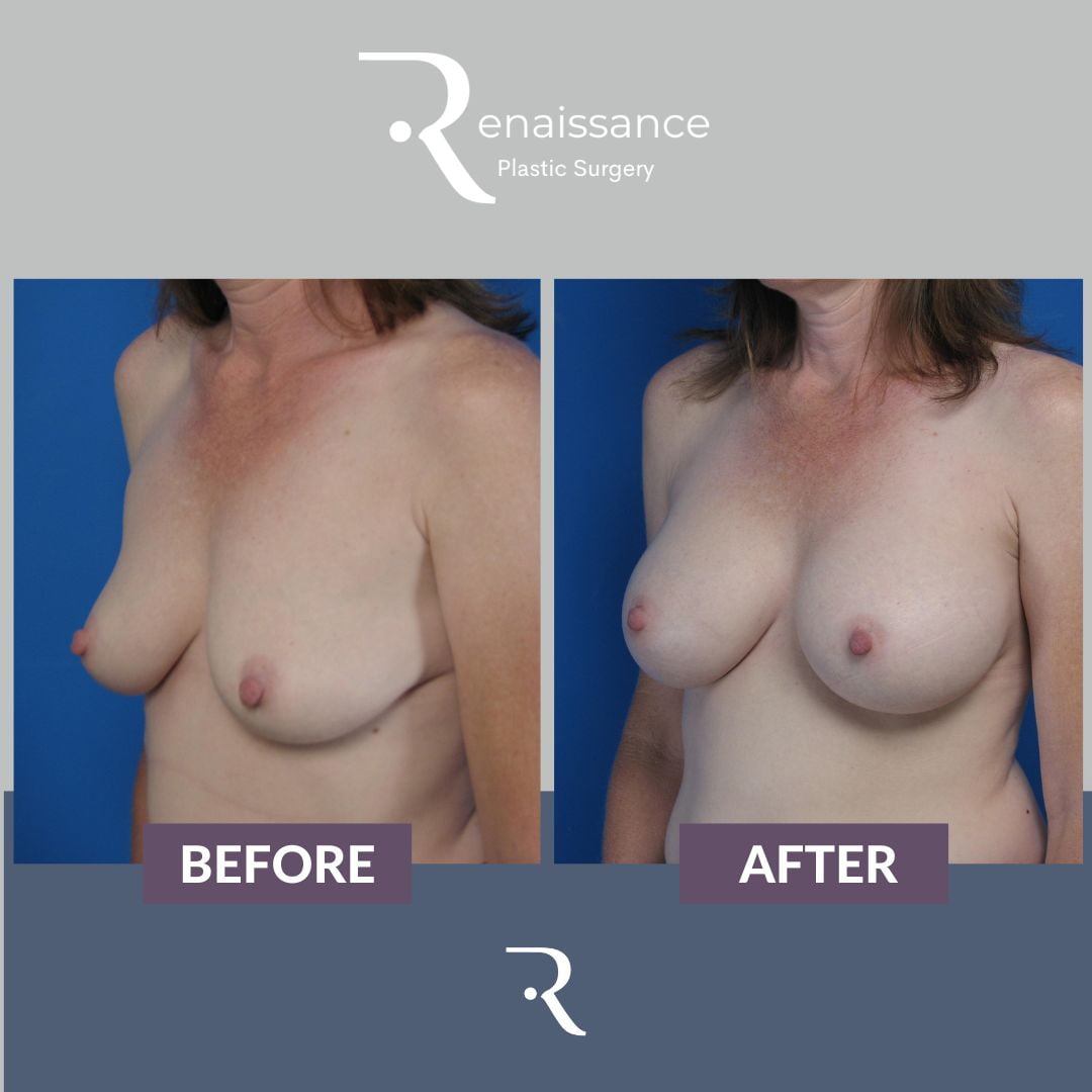 Breast Augmentation Before and After 8 - Side