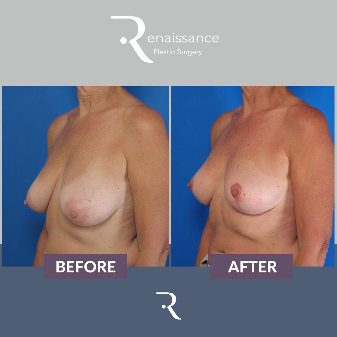 Breast Lift Before and After 1 - Side