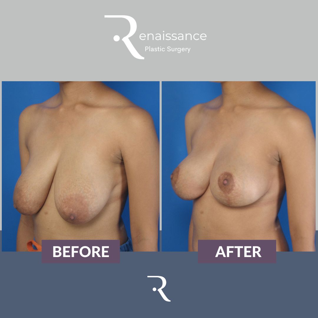 Breast Lift Before and After 2 - Side