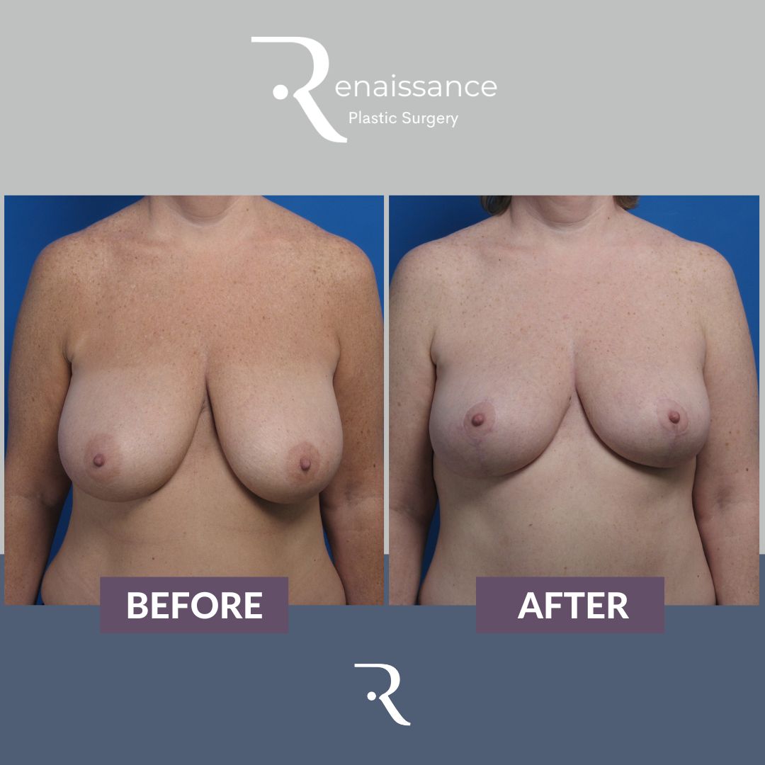 Breast Lift Before and After 4 - Front