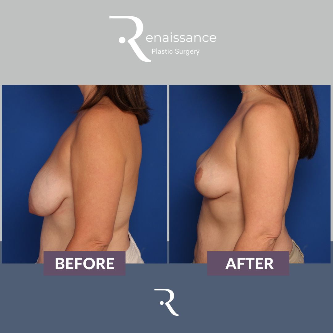 Breast Lift Before and After 7 - Side