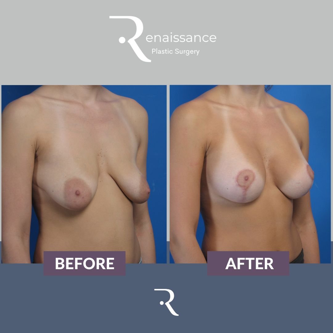 Breast Lift and Augmentation Before and After 1 - Side