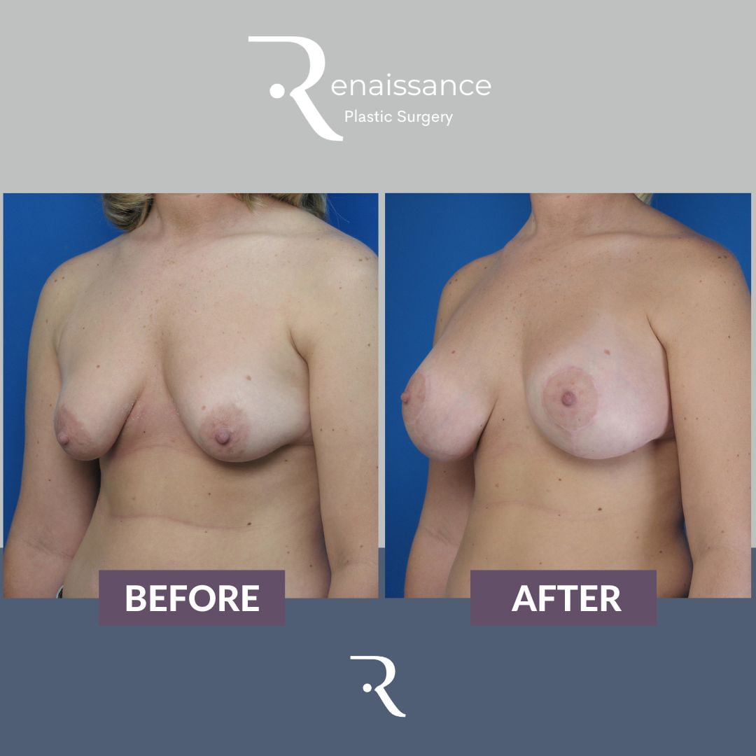 Breast Lift and Augmentation Before and After 2 - Side