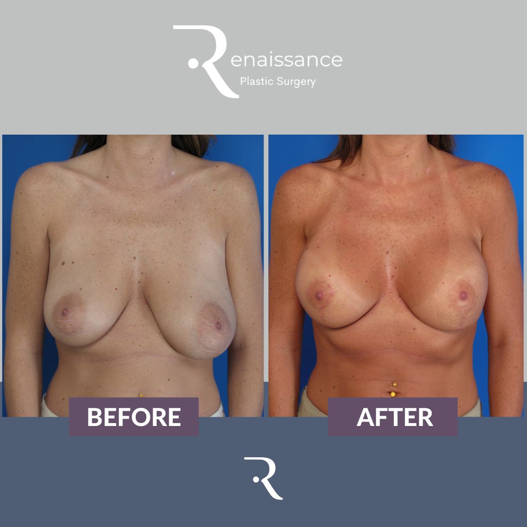 Breast Lift and Augmentation Before and After 4 - Front