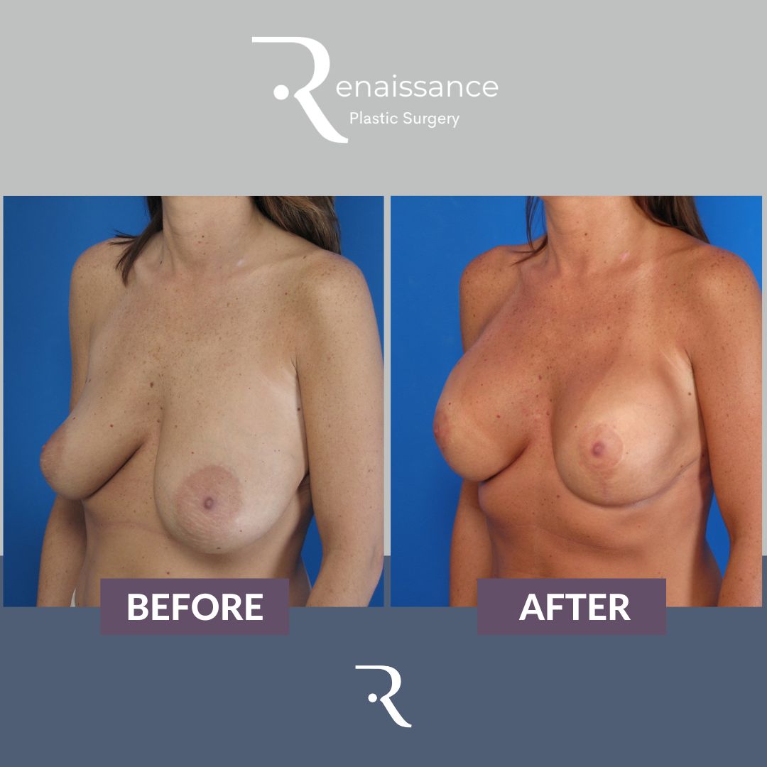 Breast Lift and Augmentation Before and After 4 - Side