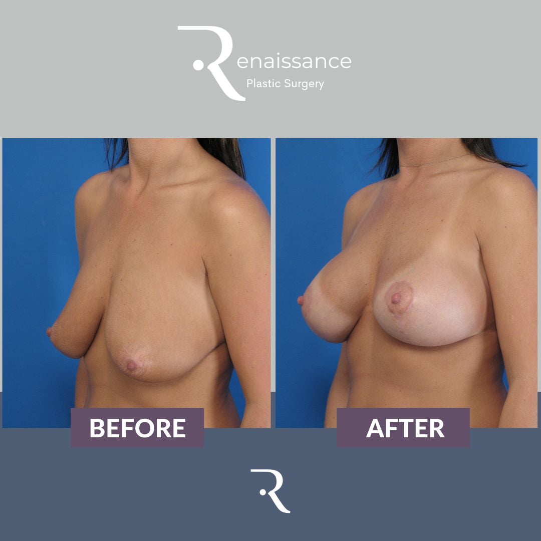 Breast Lift and Augmentation Before and After 5 - Side