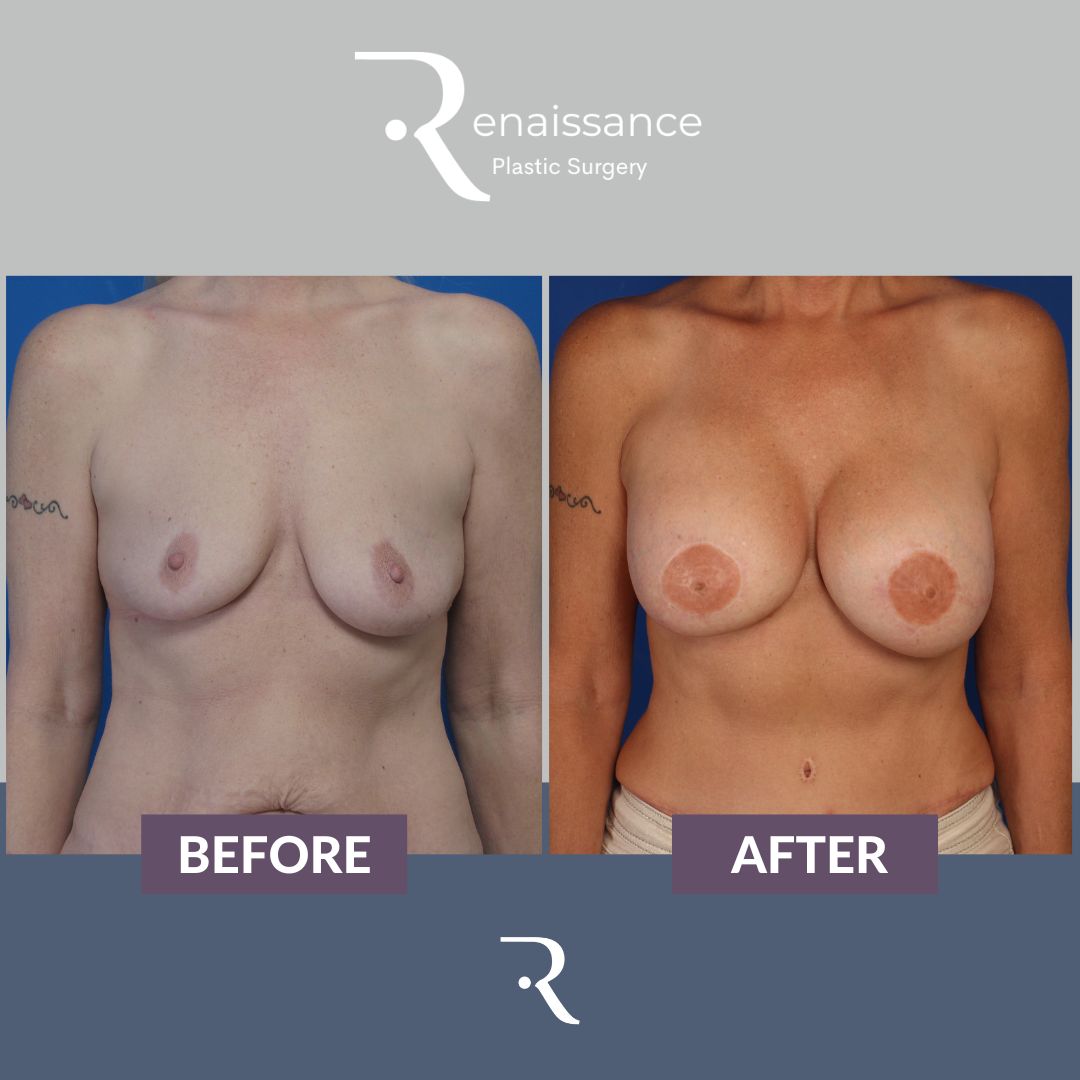 Breast Reconstruction FREE TRAM Before and After 2 - Front