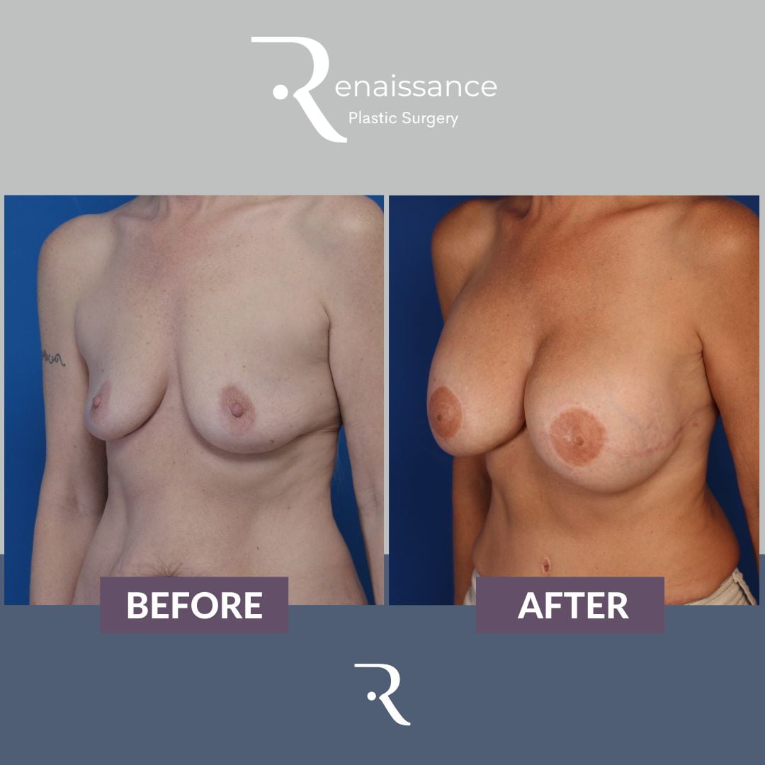 Breast Reconstruction FREE TRAM Before and After 2 - Side