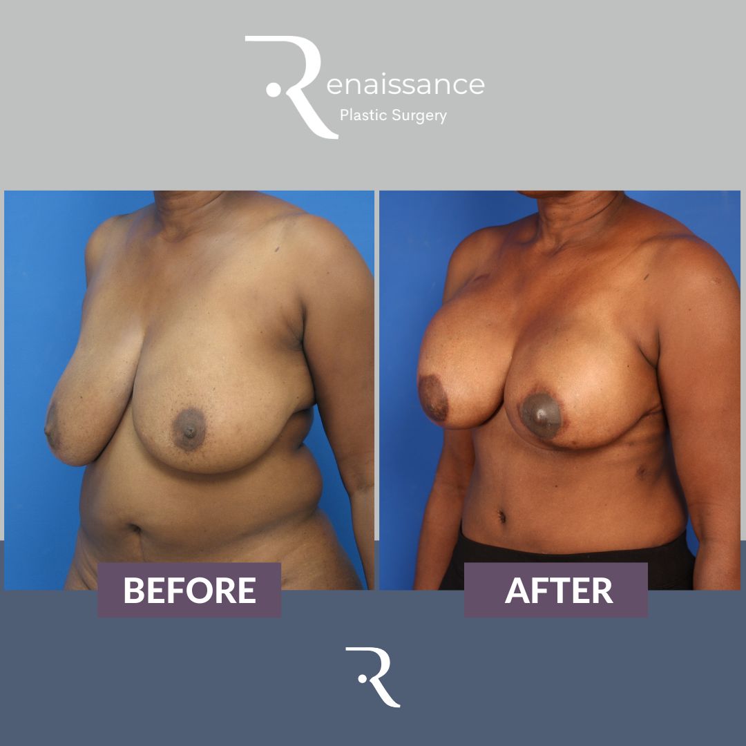 Breast Reconstruction FREE TRAM Before and After 3 - Side