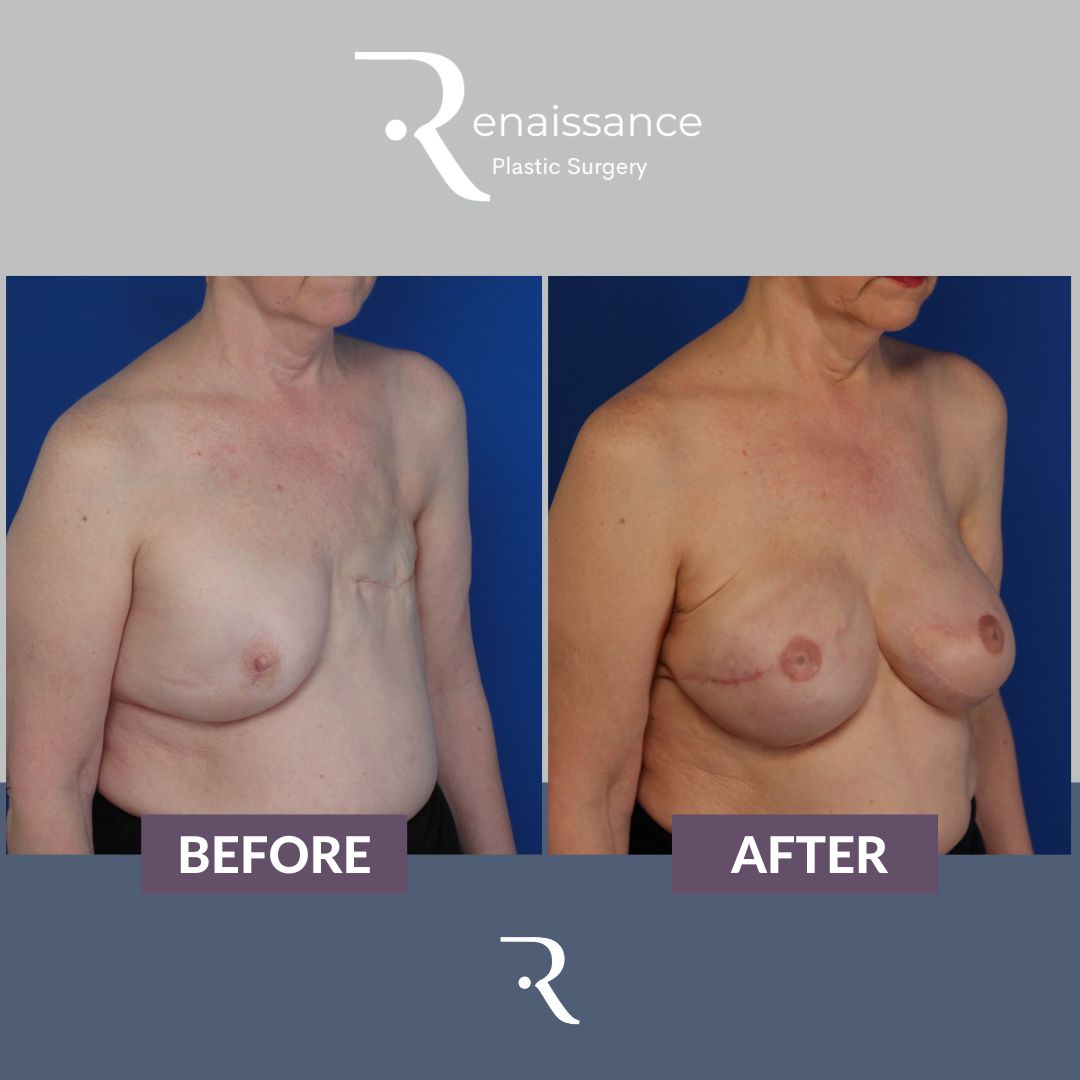 Breast Reconstruction LD FLap Before and After 1 - Side