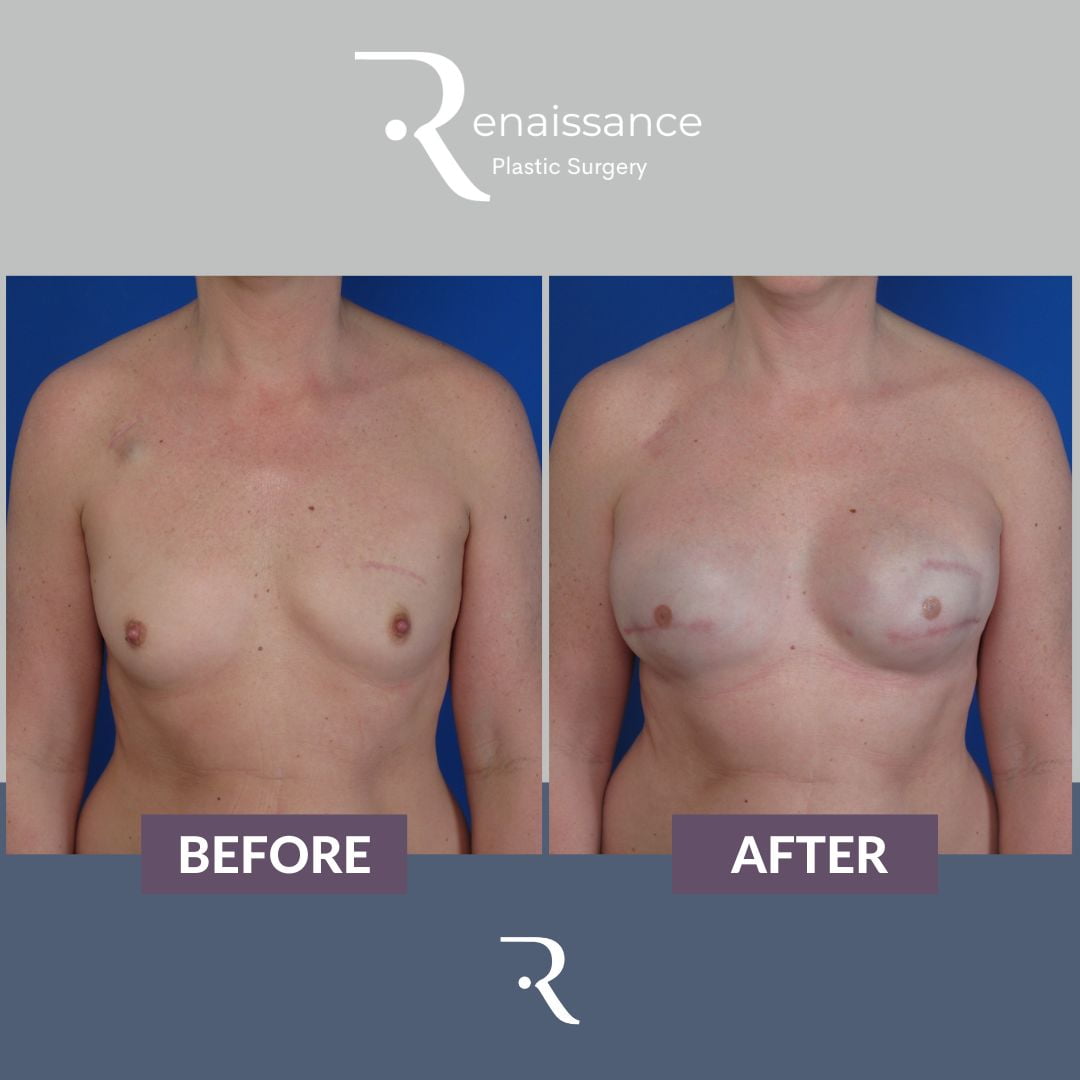Breast Reconstruction Tissue Expander Before and After 1 - Front