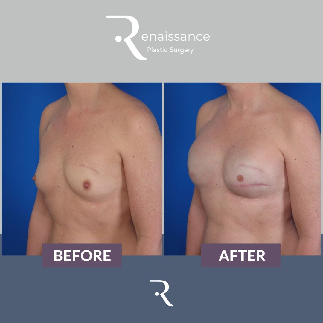 Breast Reconstruction Tissue Expander Before and After 1 - Side