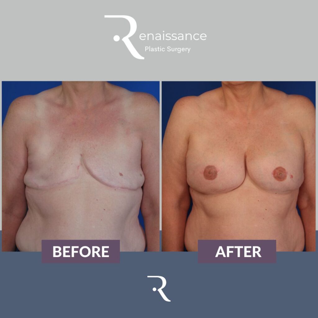 Breast Reconstruction Tissue Expander Before and After 2 - Front