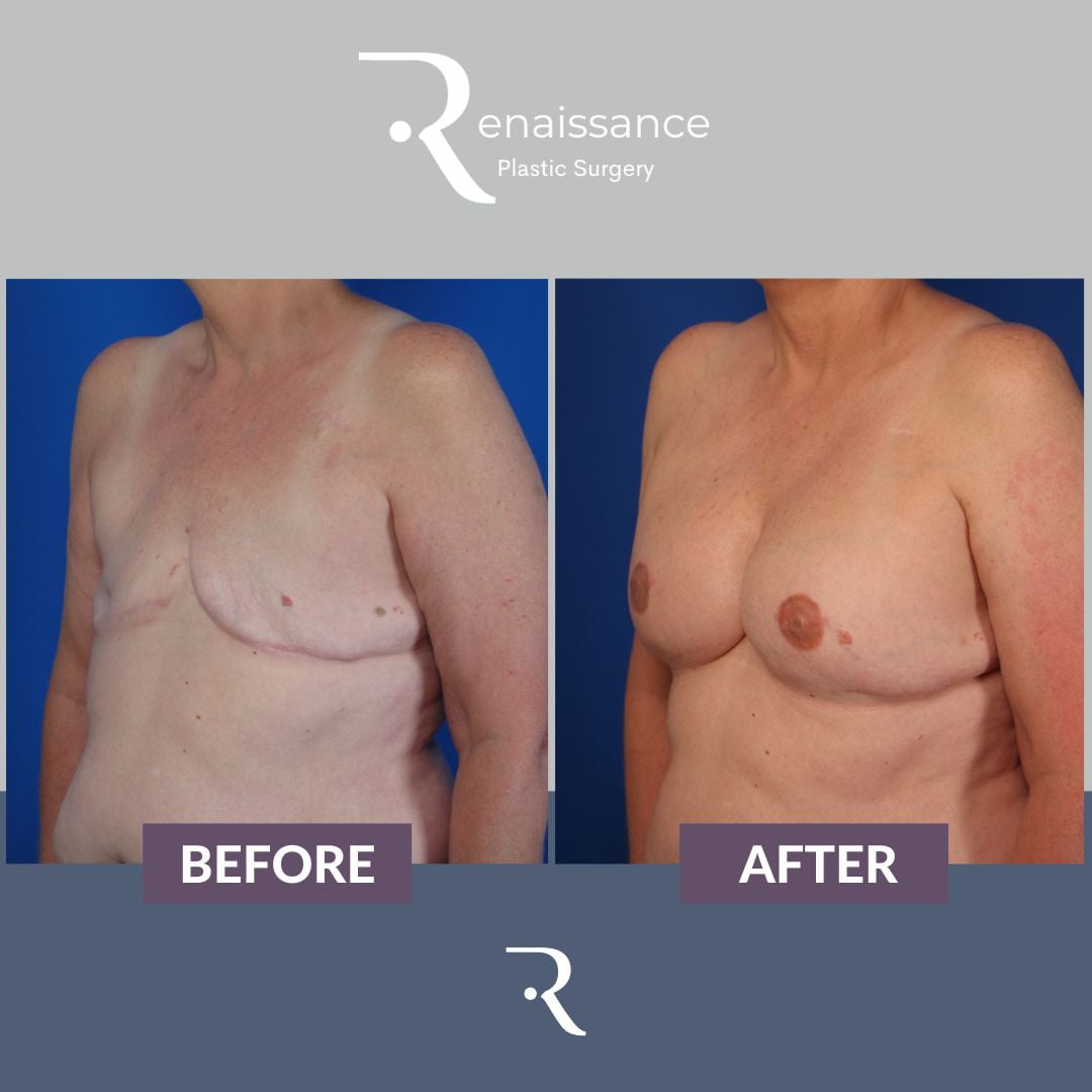 Breast Reconstruction Tissue Expander Before and After 2 - Side