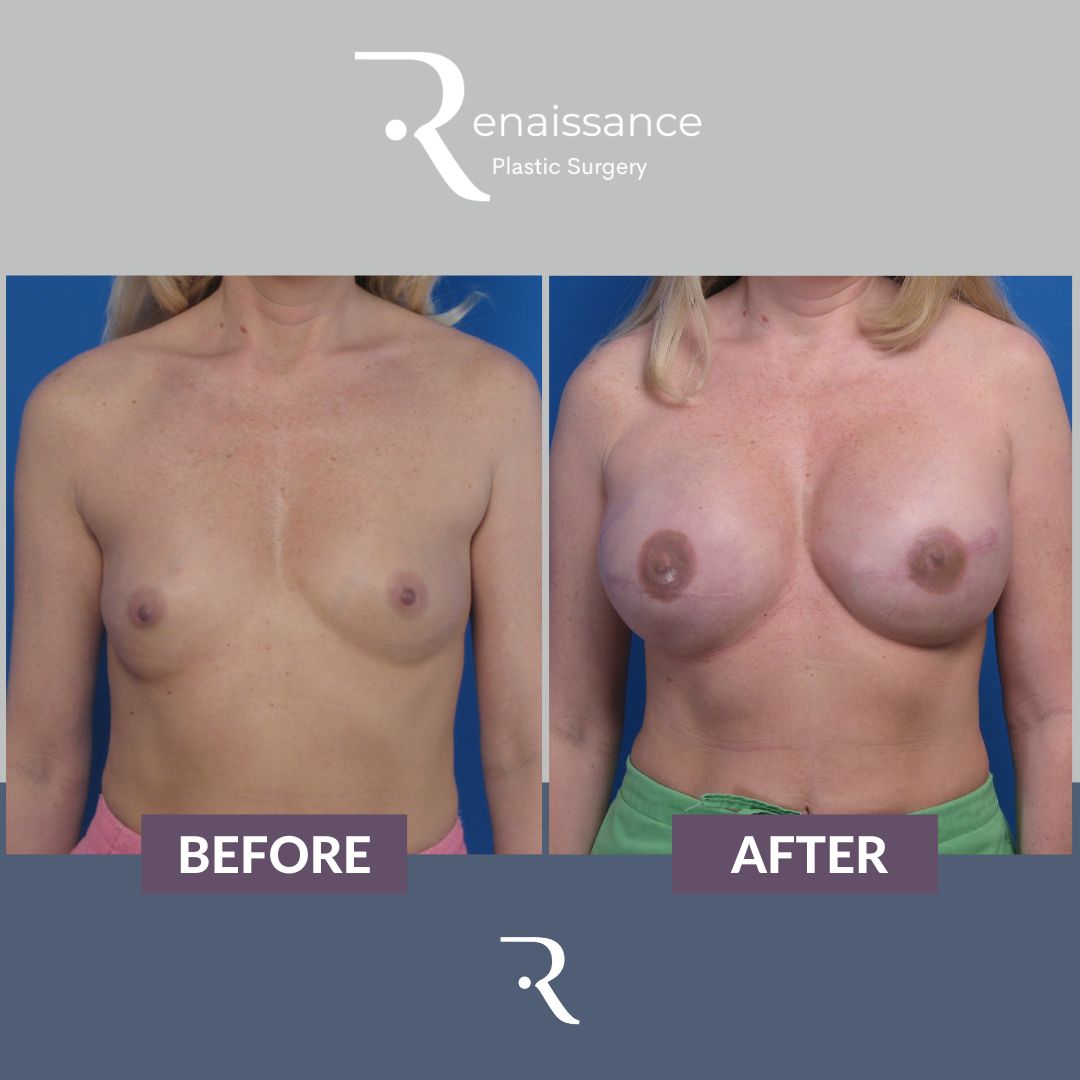 Breast Reconstruction Tissue Expander Before and After 3 - Front