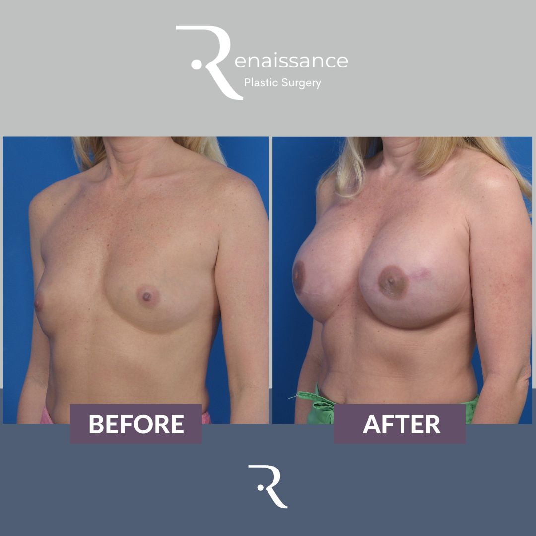 Breast Reconstruction Tissue Expander Before and After 3 - Side