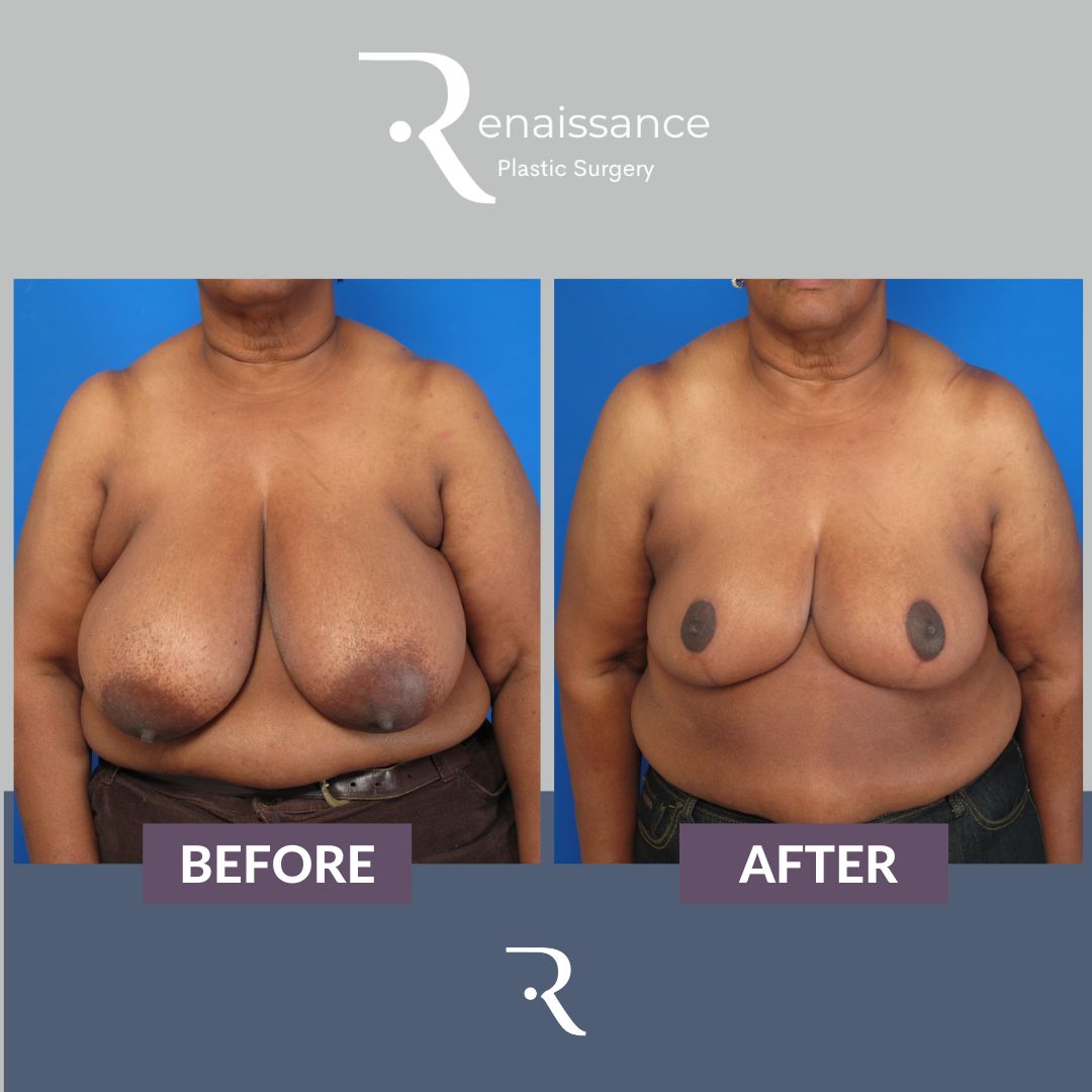 Breast Reduction Before and After 1 - Front