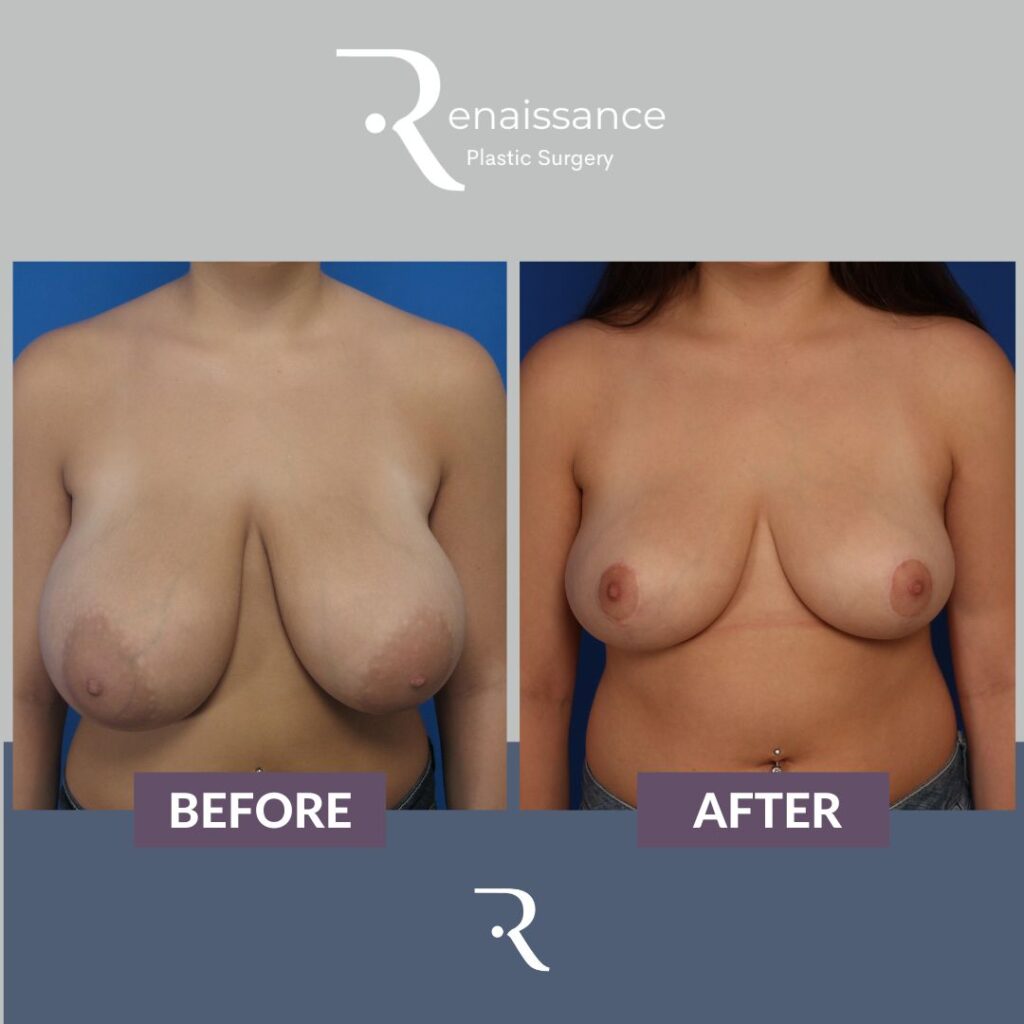 Breast Reduction Before and After 10 - Front
