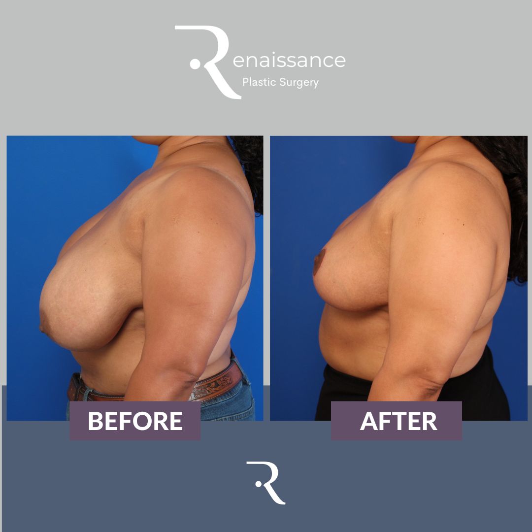 Breast Reduction Before and After 11 - Side