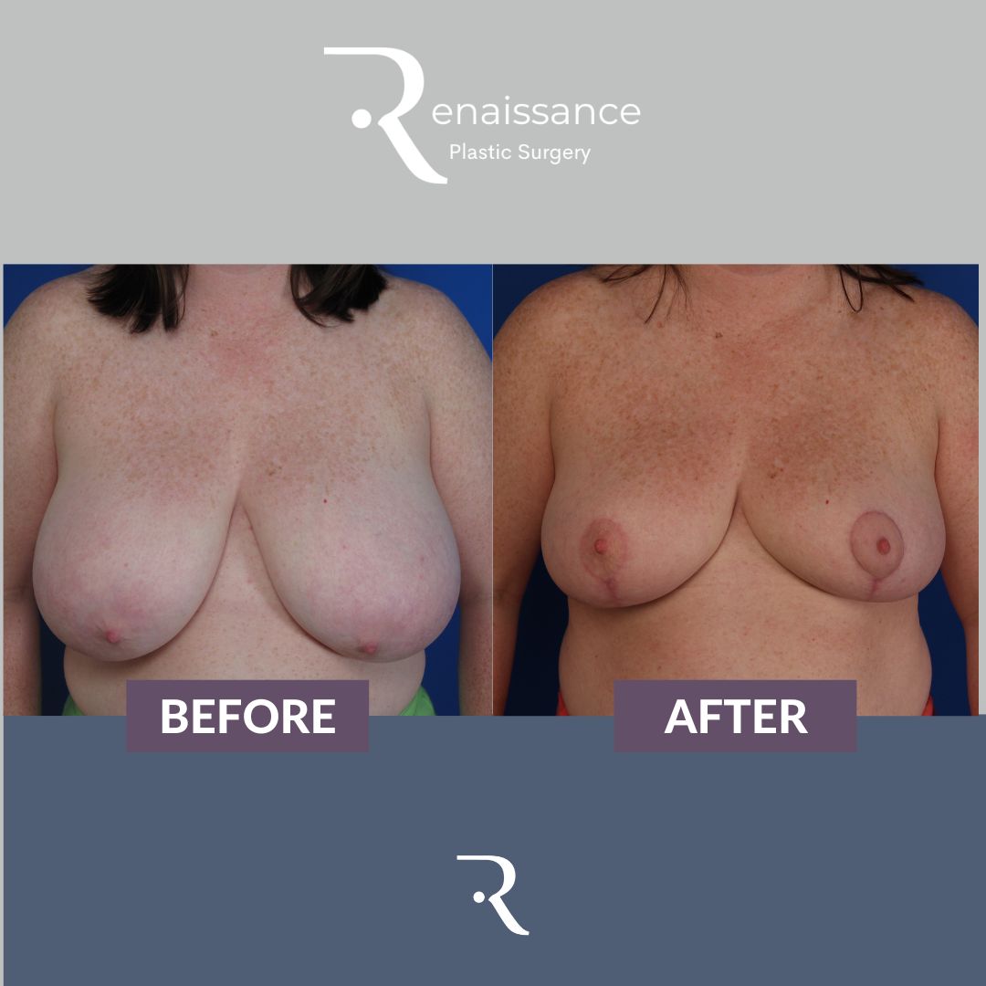 Breast Reduction Before and After 12 - Front