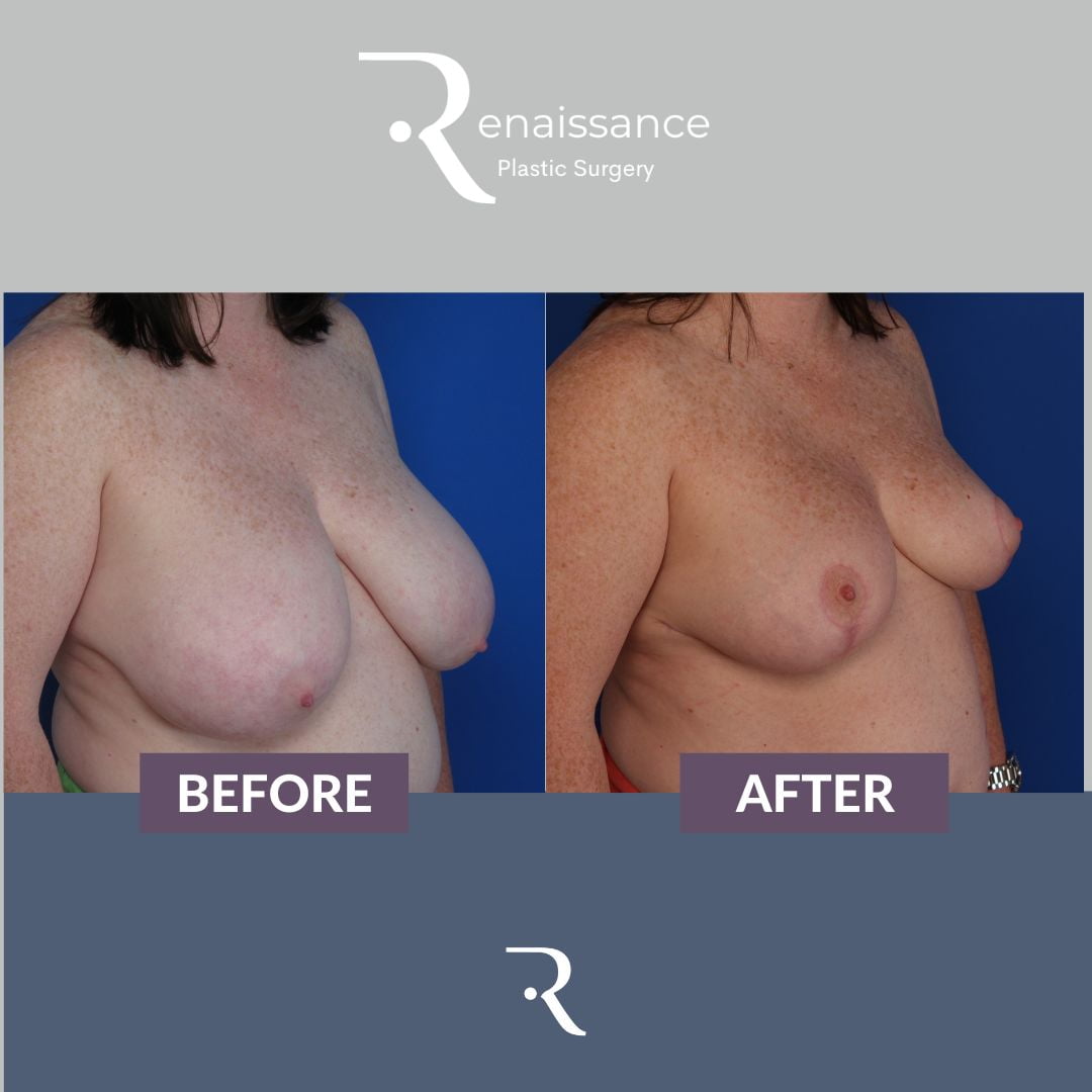 Breast Reduction Before and After 12 - Side