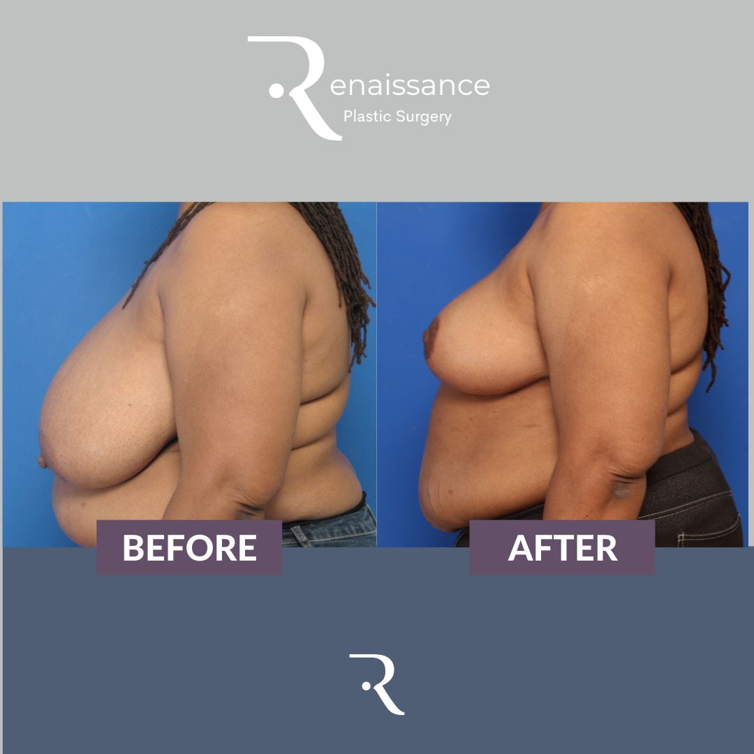 Breast Reduction Before and After 13 - Side