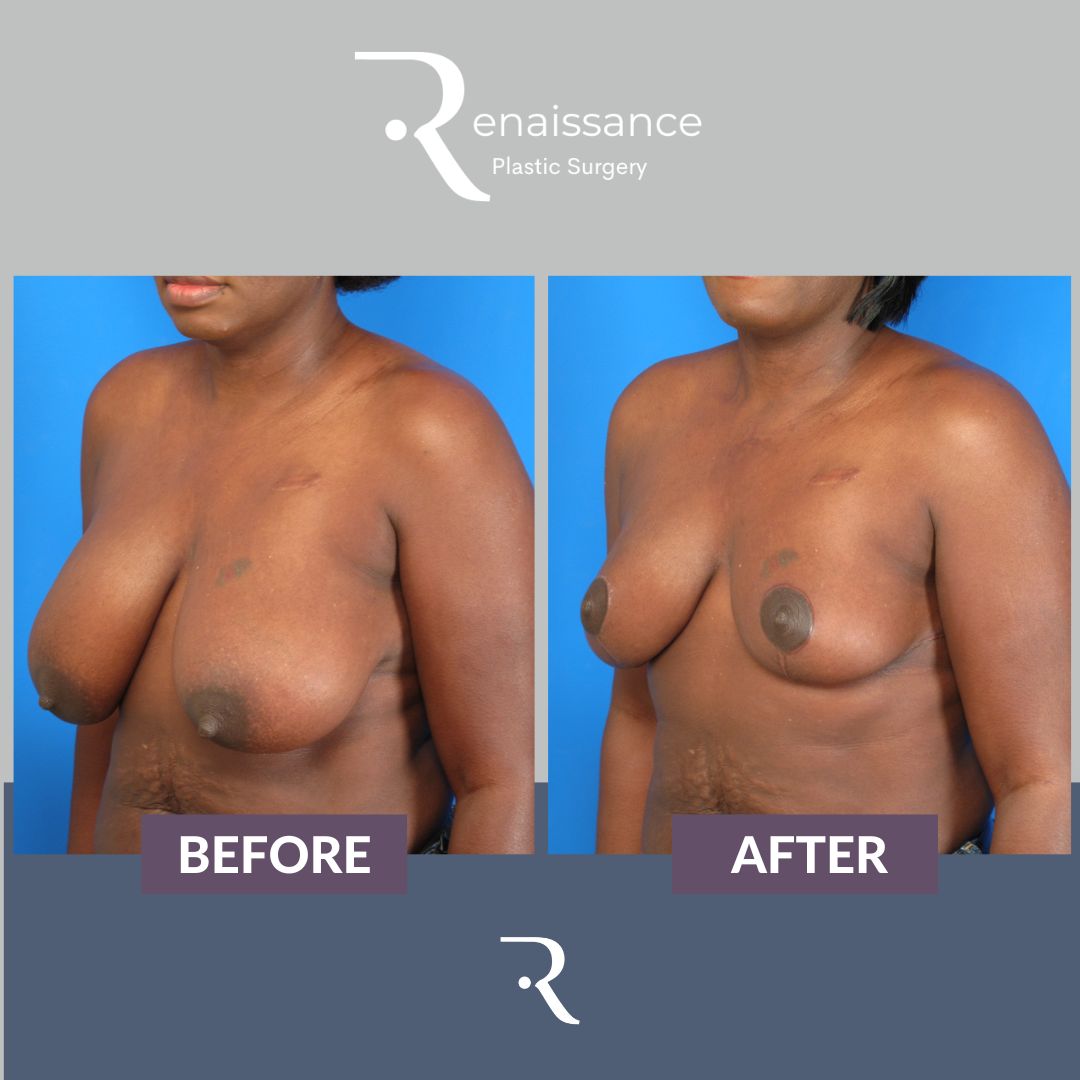Breast Reduction Before and After 2 - Side
